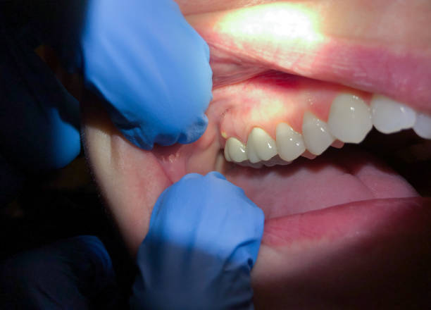 Best Urgent Care for Lost Fillings or Crowns in National City, CA