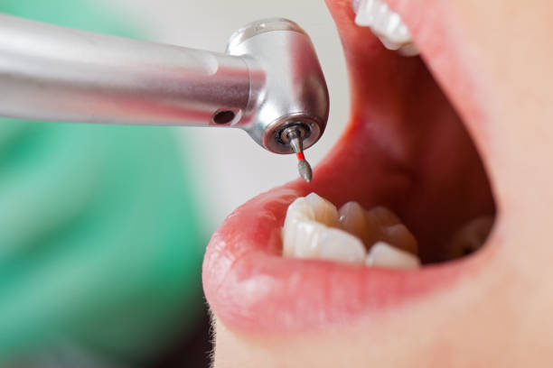 Best Emergency Gum Treatment in National City, CA